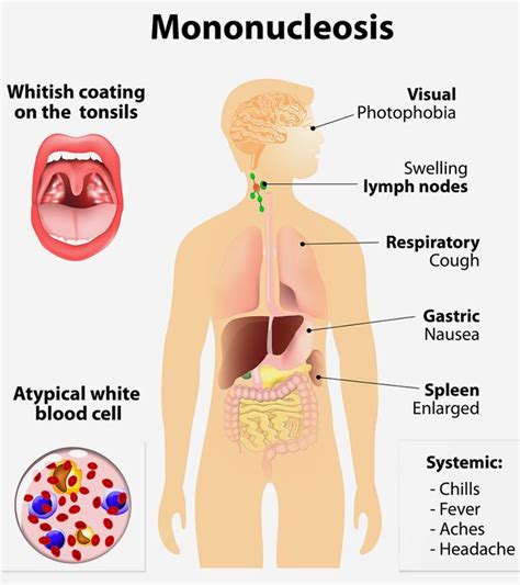 Mono In Kids: Causes, Symptoms, Treatment And Prevention