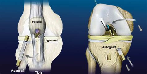 ACL Reconstruction