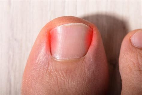 Ingrown Toenail – Podiatry on Plenty