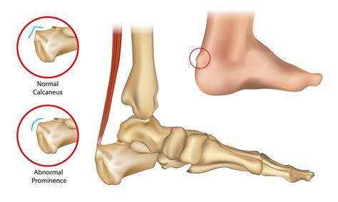 Haglund’s Deformity | Milton Orthotic & Wellness Centre