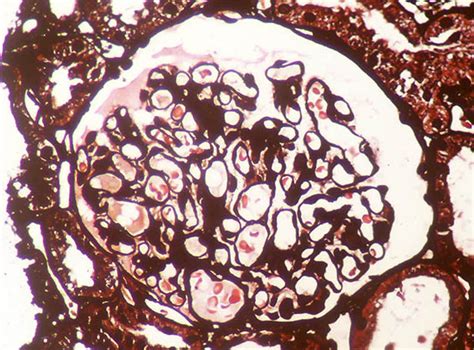 Proteinuria - Glucosuria