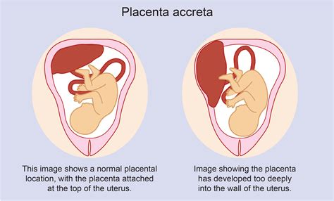 Placenta accreta | Pregnancy Birth and Baby