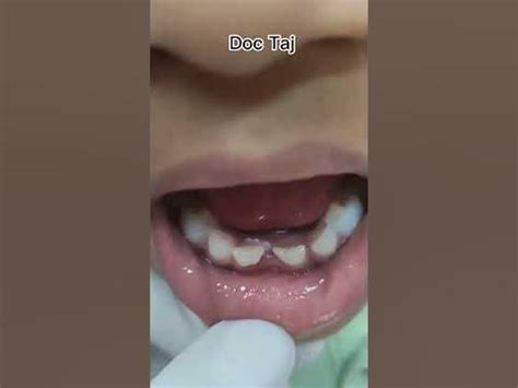 Fusion of milk teeth/Tooth Anomaly/Gemination/ Teeth extraction/ Doc ...