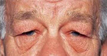 Dermatochalasis & Blepharoplasty | South Texas Eye Institute