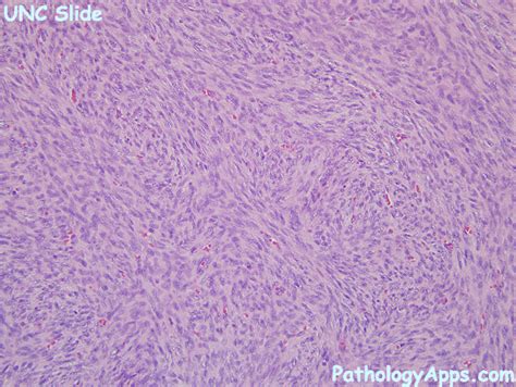 Dermatofibrosarcoma protuberans