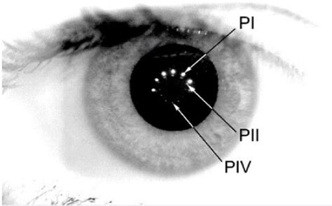 An illustrative example of Purkinje images captured in the healthy... | Download Scientific Diagram