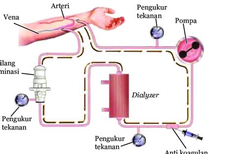 Apa Hemodialisis Itu Jelaskan Secara Singkat – Ujian