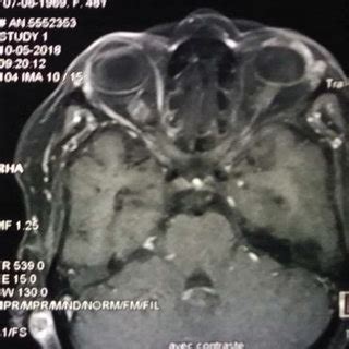 MRI objectifying a voluminous cerebellar lesion enhanced after... | Download High-Resolution ...