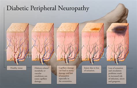 Apa yang dimaksud dengan Neuropati Diabetika ? - #2 by kirei - Ilmu ...