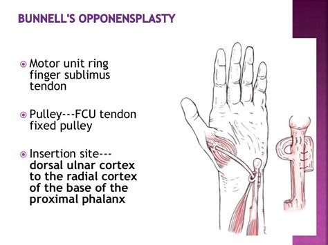 Ape thumb deformity to publish