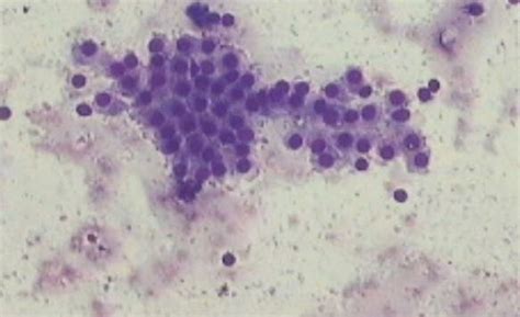 FNAC thyroid of same case showing monolayered sheet of benign ...