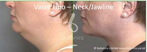 Vaser Lipo Female Neck/Jawline - botonics