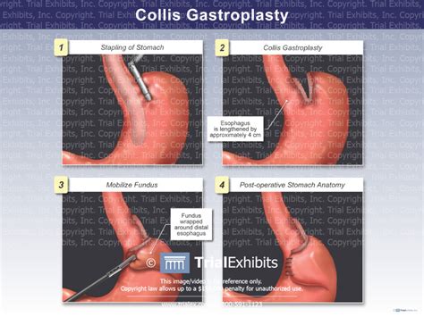 Collis Gastroplasty - TrialQuest Inc.