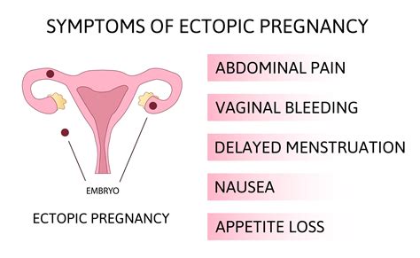 Signs of an Ectopic Pregnancy - This Little Nest