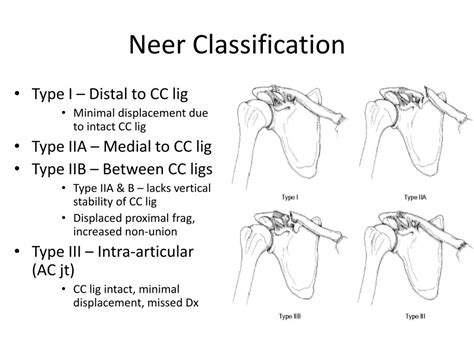 Distal Clavicle Fracture Classification