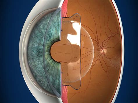 Phakic IOL (ICL Lens Implant)