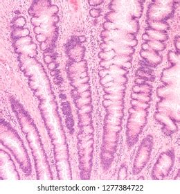 Microscopic Histology Tubular Adenoma Adenomas Premalignant库存照片 ...