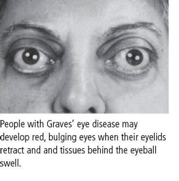 Graves' eye disease (Graves' ophthalmopathy) Guide: Causes, Symptoms ...