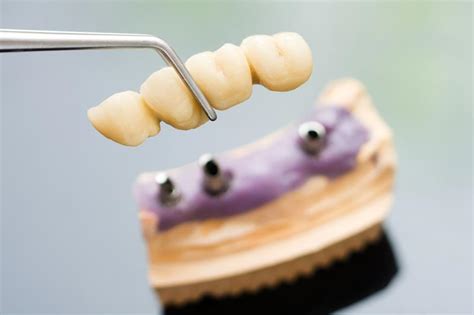 Dental Porcelain Bridges in Eagan, MN | Shirene Orandi, DDS