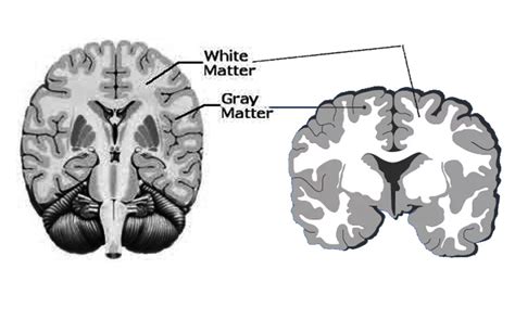 [Figure, Gray and White matter. Image courtesy S Bhimji MD] - StatPearls - NCBI Bookshelf