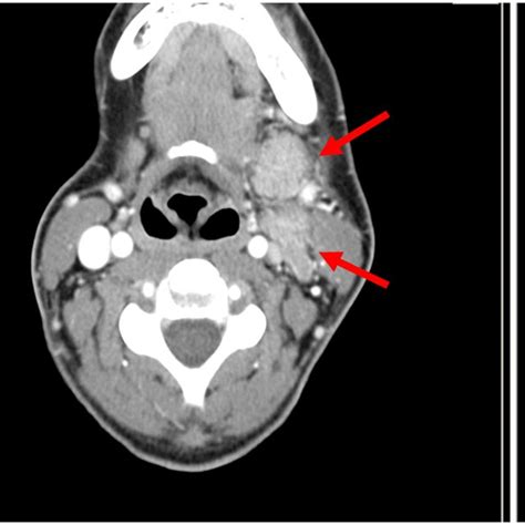 CT scan of the head with submandibulary gland tumor, multiple nodes and... | Download Scientific ...