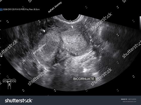 Transvaginal Ultrasound Uterus Bicornuate Uterus Transverse Stock Photo ...