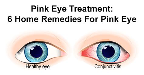 Pankaj Kashyap: Pink Eye Treatment: 6 Simple Home Remedies For Pink Eye