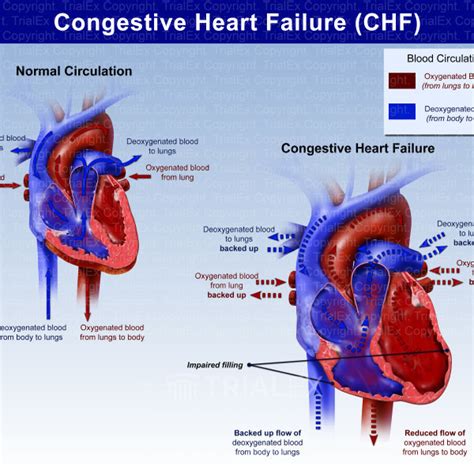 Congestive Heart Failure (CHF) - TrialQuest Inc.