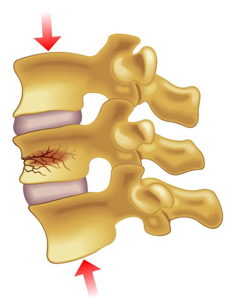 Compression Fracture - ONZ Spine