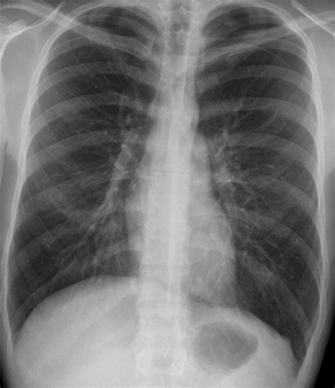 Pneumothorax – Undergraduate Diagnostic Imaging Fundamentals