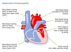 Children's Heart Federation | Hypertrophic cardiomyopathy