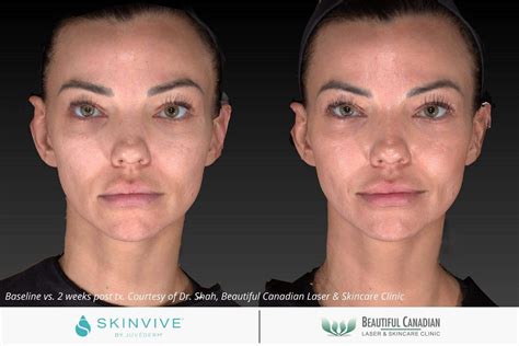 Vancouver Juvéderm SkinVive (a.k.a. VOLITE®) skin booster (Surrey)