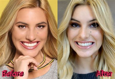 Lele Pons Nose Job: A Good Idea and A Good Result