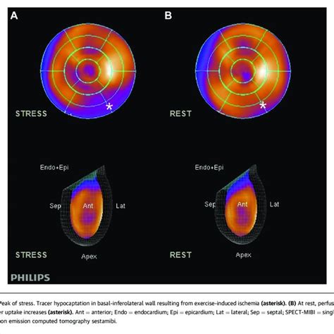 SPECT-MIBI Stress-Testing Bullseye | Download Scientific Diagram