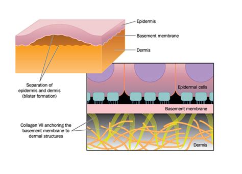 Dystrophic epidermolysis bullosa: MedlinePlus Genetics