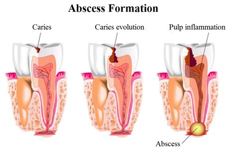 What is phoenix dental abscess? | News | Dentagama