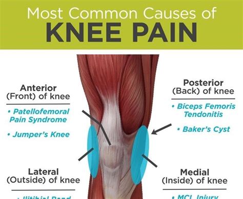 Knee Pain: Common Causes Of Knee Pain | Pain In The Kneecap Area | jsandanski-strumica.edu.mk