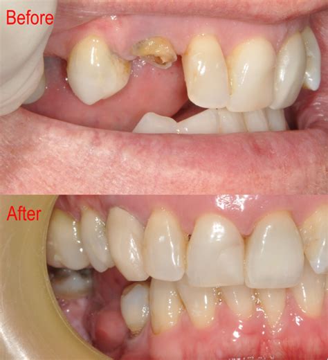 Before and After # 3 | Burpengary Dental