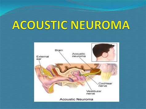 Acoustic neuroma