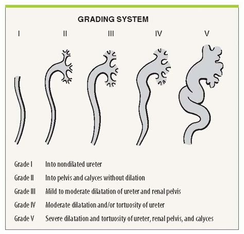 Vesicoureteral Reflux | Abdominal Key