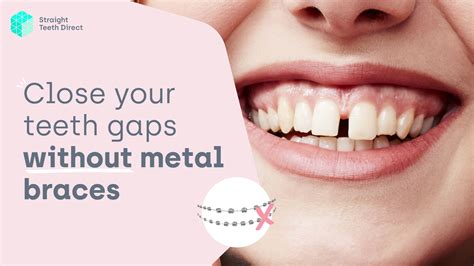 teeth gaps Archives - Straight Teeth Direct