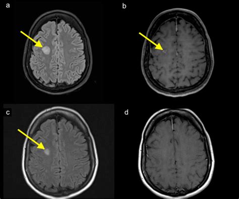 MRI Brain. a. Hyperintense FLAIR signal white matter lesion in the... | Download Scientific Diagram