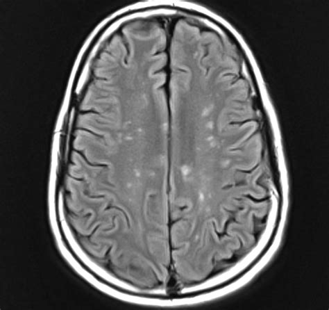 Axial flair MRI showing multifocal gray and white matter supratentorial ...