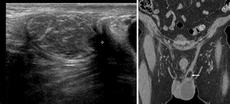 Incidental left spermatic cord lipoma. a Longitudinal US of the left ...