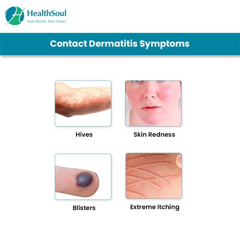 Contact Dermatitis: Causes, Diagnosis and Treatment | Dermatology | HealthSoul