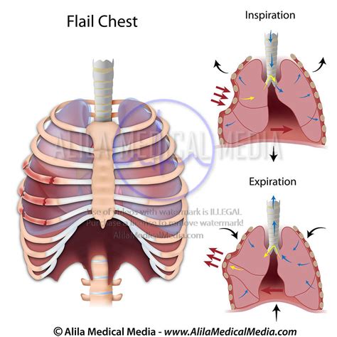 Alila Medical Media | Flail chest. | Medical illustration