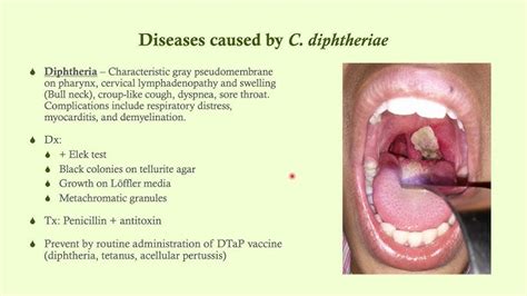 Diphtheria Bull Neck