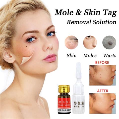 Buy Mole Skin Tag Removal Solution Painless Mole Skin Dark Spot Removal ...