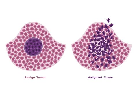 Benign vs. Malignant Tumors: What's the Difference?