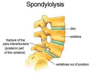 Spondylolysis - Biokineticist Andries Lodder | Bio4Me